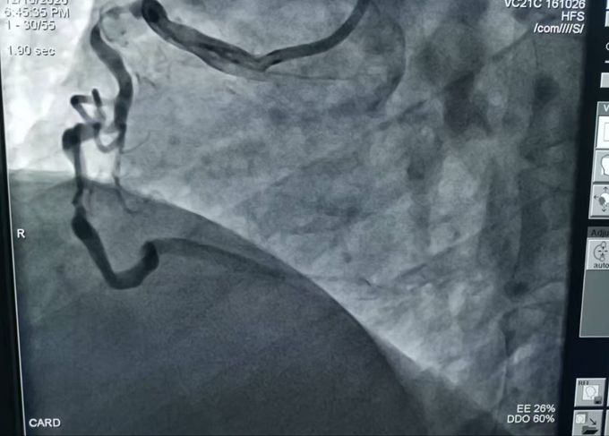 3根心臟動(dòng)脈血管嚴(yán)重堵塞 危及生命！十堰人醫(yī)2次手術(shù)為七旬大爺解除“警報(bào)”