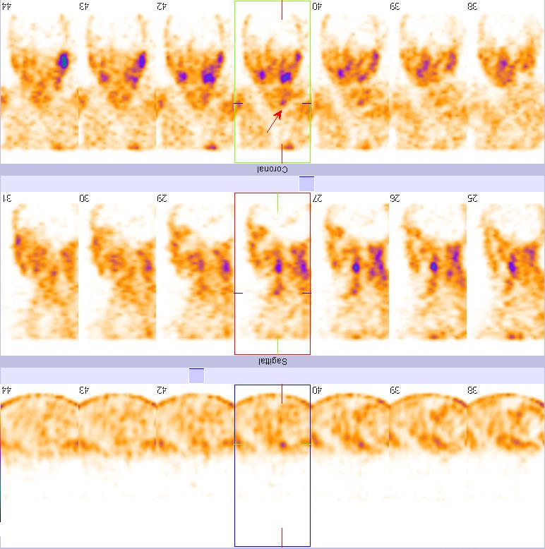 甲狀腺親腫瘤顯像檢查流程及注意事項(xiàng)