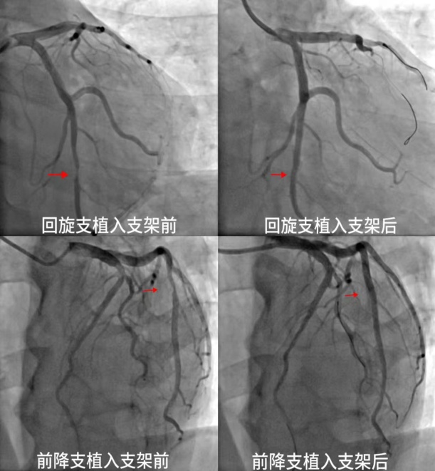 “生命通道”重獲生機，十堰人醫(yī)成功救治復雜冠心病危重患者