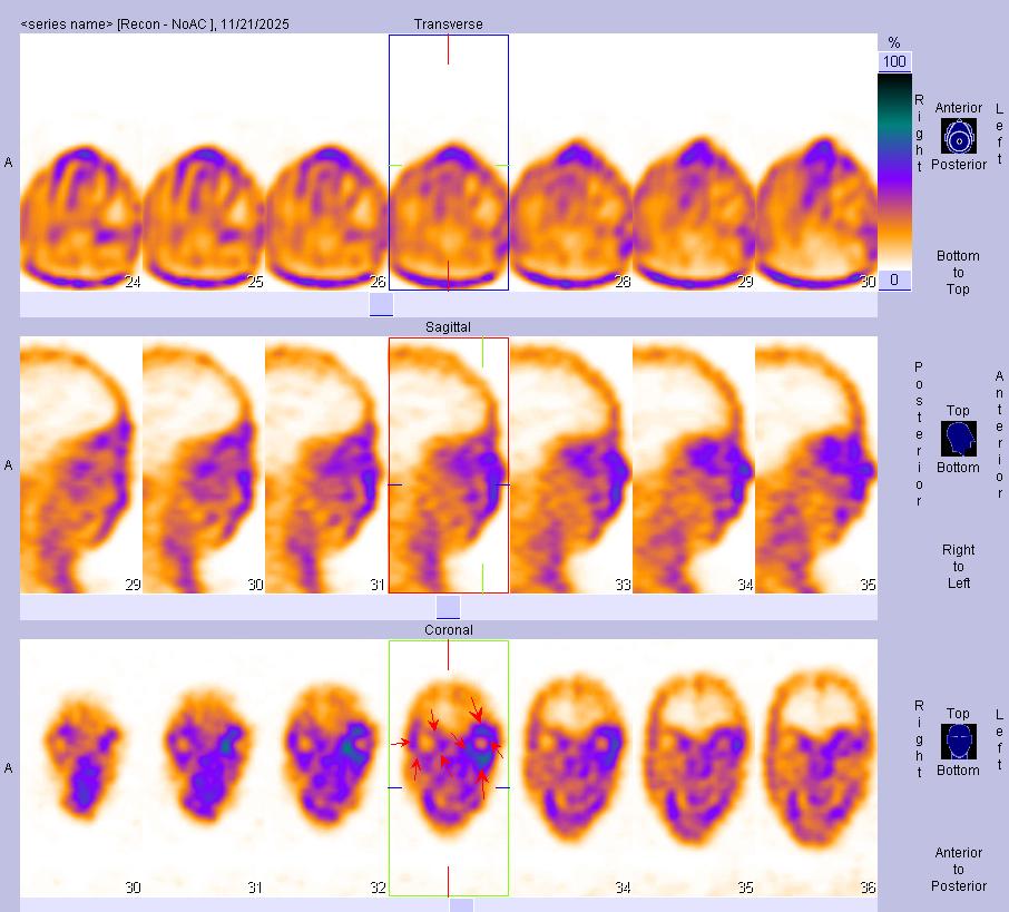 十堰人醫(yī)核醫(yī)學科：甲狀腺相關(guān)性眼病顯像檢查流程及注意事項
