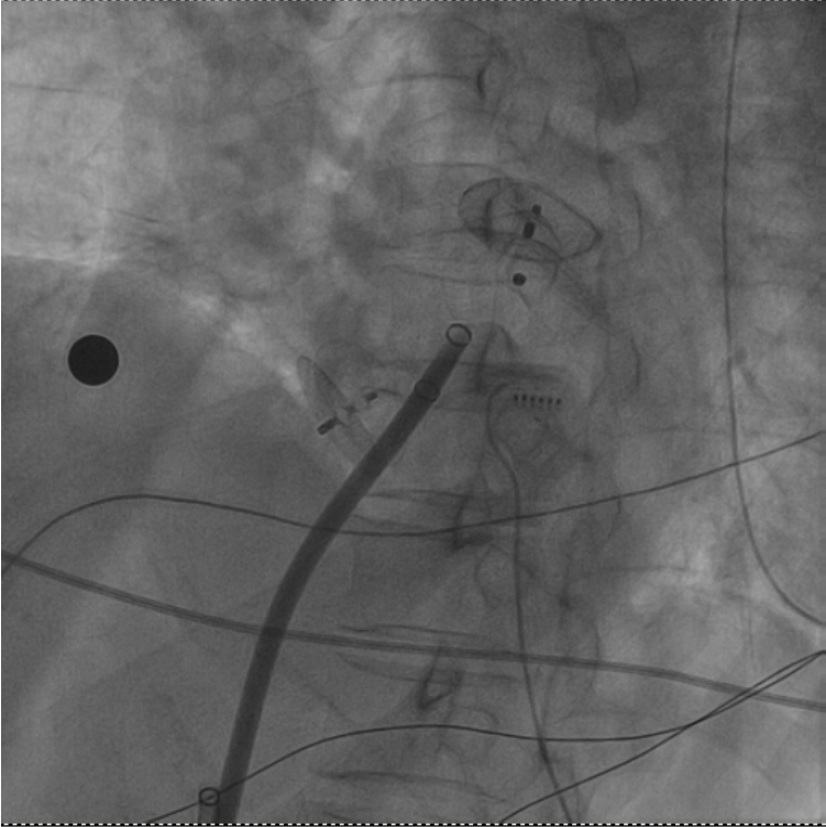 一次穿刺行兩個手術！十堰人醫(yī)成功消除圓孔封堵術后的房顫與血栓