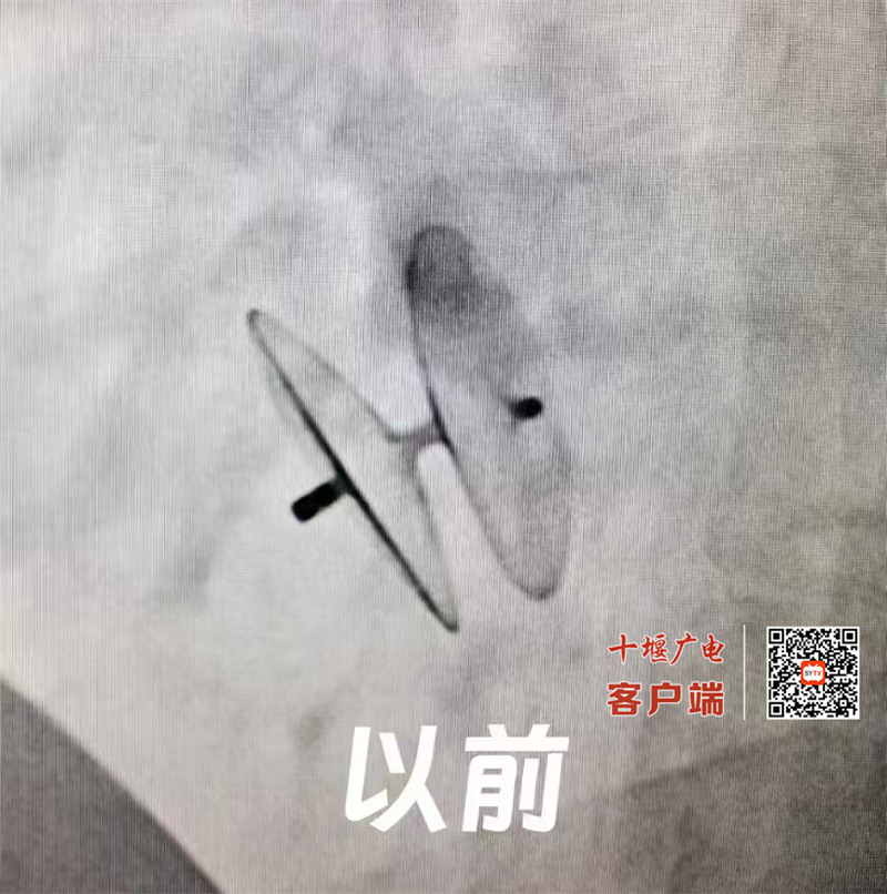 十堰人醫(yī)可降解封堵器治療卵圓孔未閉取得成功