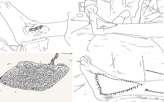 十堰市人民醫(yī)院成功實(shí)施高難度皮瓣移植術(shù) 直面挑戰(zhàn)創(chuàng)奇跡 治愈患者獲贊譽(yù)