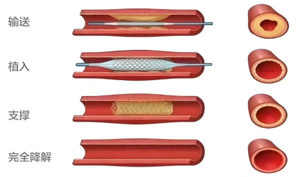 十堰首例！“無痕”支架植入術(shù)成功實施