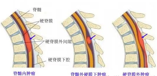 腰腿痛元兇：竟是椎管內(nèi)腫瘤！十堰人醫(yī)精準(zhǔn)除瘤阻截癱