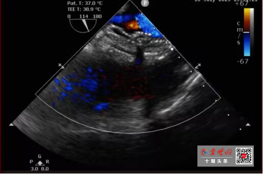全國首例！十堰人醫(yī)“雙降解”封堵術(shù)巧補(bǔ)心臟雙“洞”不留痕