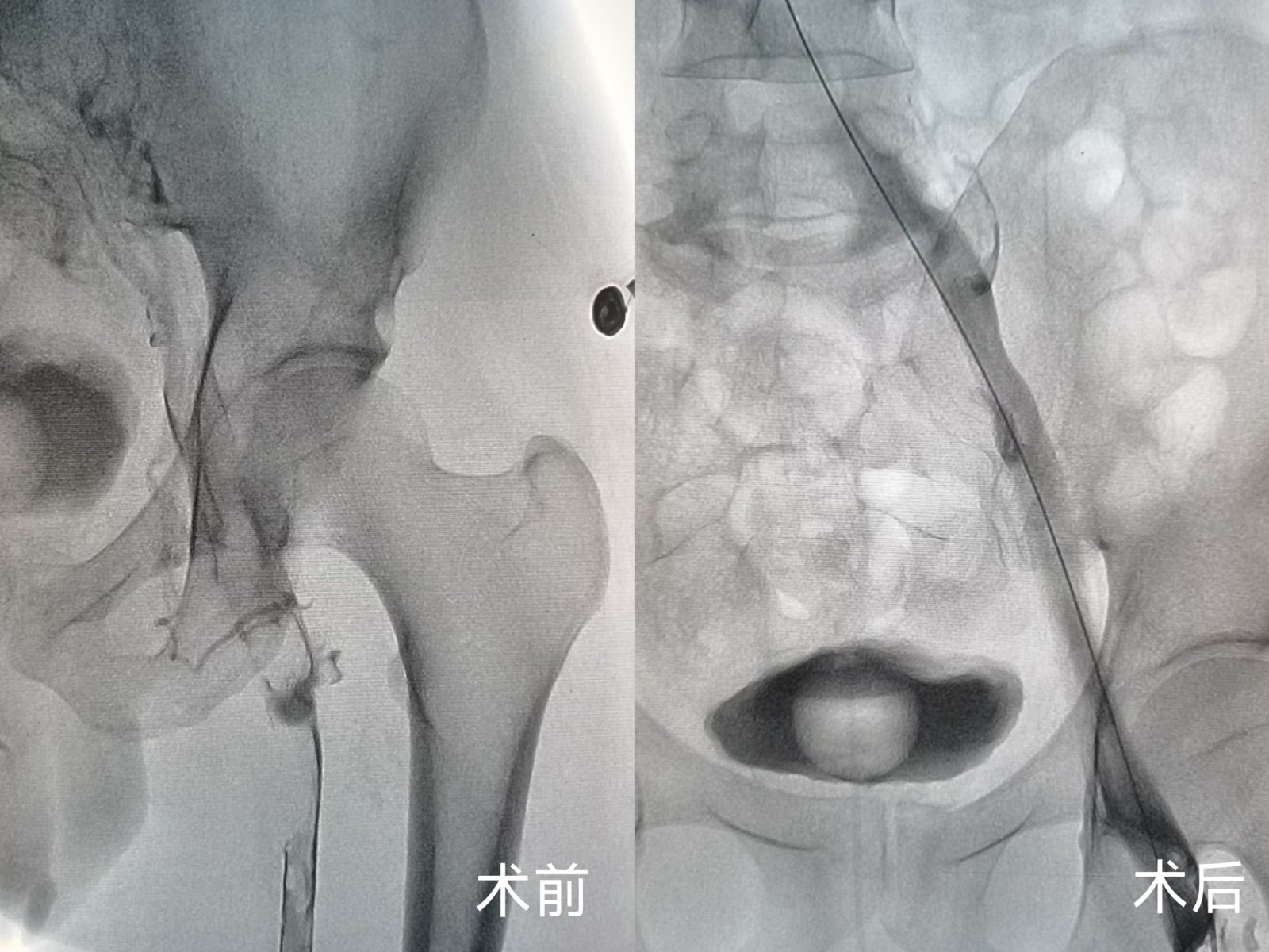 十堰人醫(yī)心胸大血管外科外周靜脈取栓支架系統(tǒng)精準(zhǔn)取栓解沉疴
